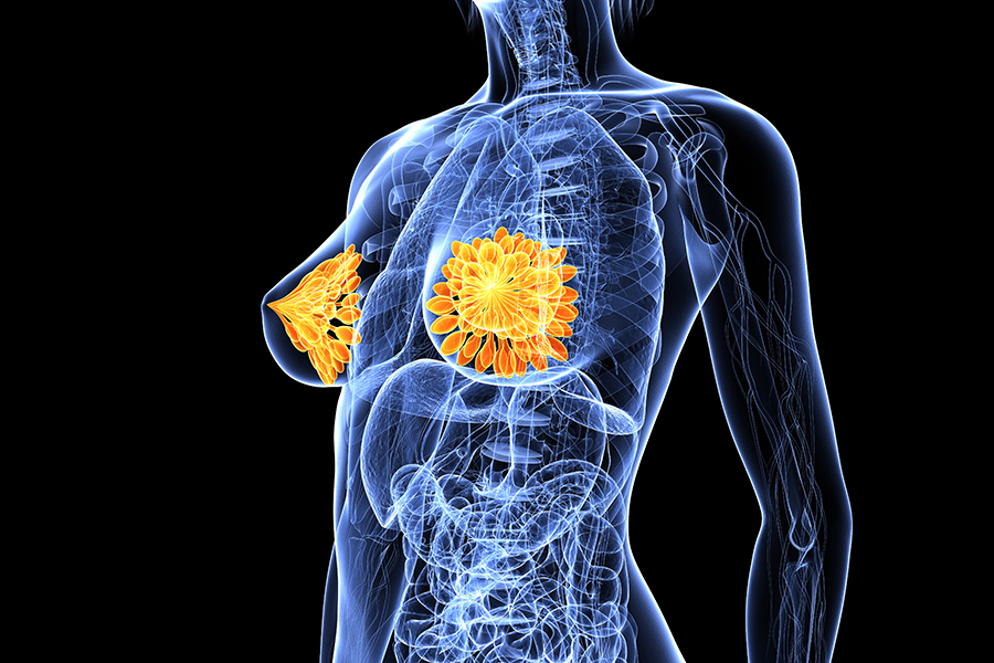 3D illustration of breast cancer