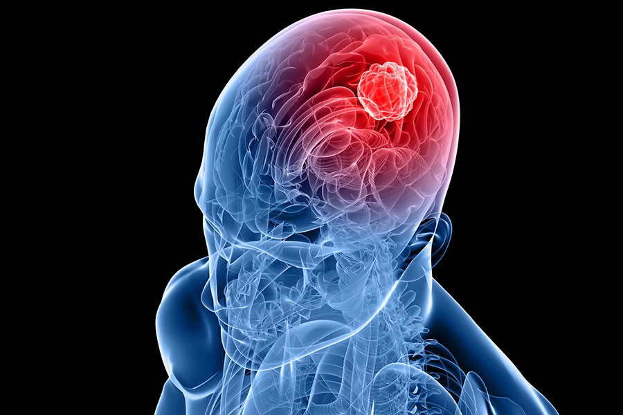 brain cancer illustration
