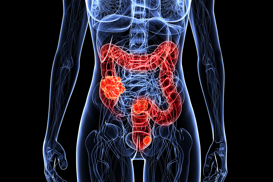 Gastrointestinal Cancer