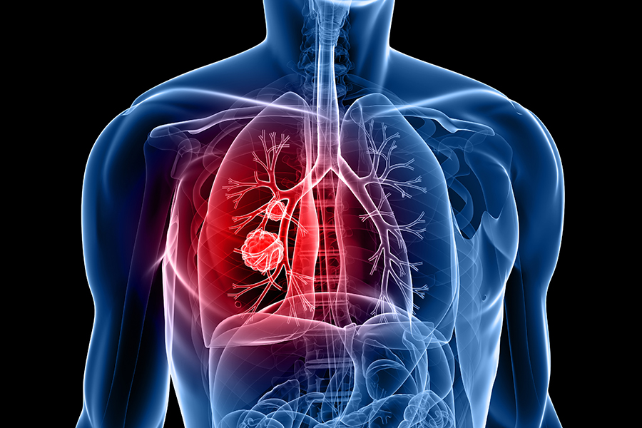 Lung and Thoracic Cancer