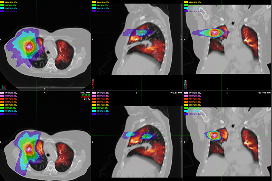 example of patient-specific response-informed treatment planning