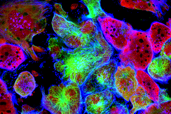 Tumor cells under microscope