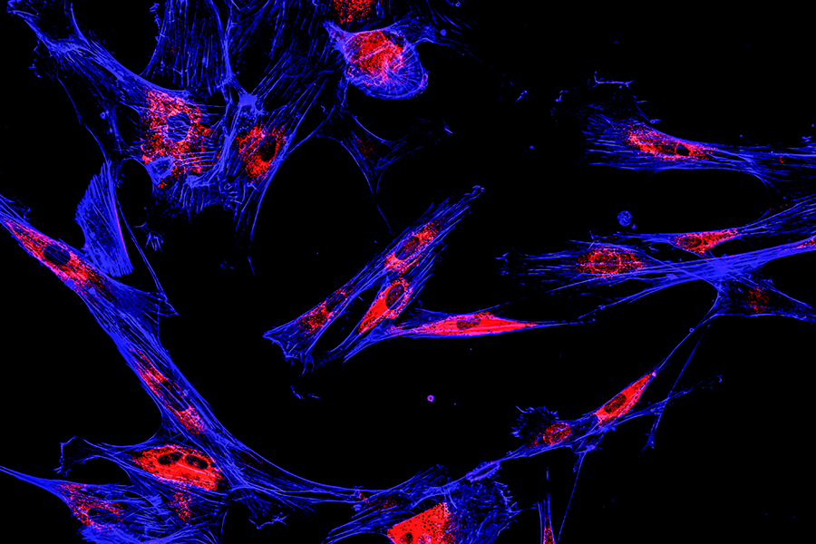 Immunofluorescence confocal imaging of melanoma cancer cells