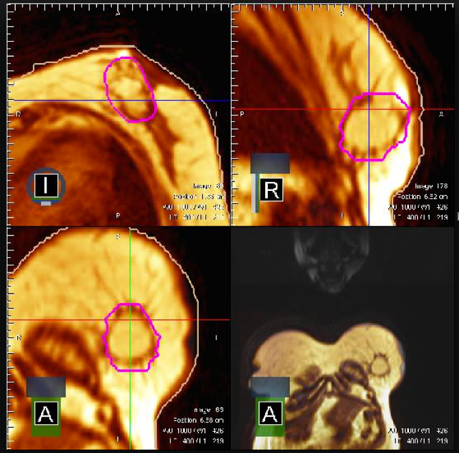 four MR images of breast cancer