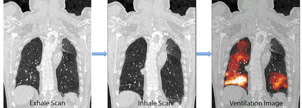 images from a 4DCT scan; one at inhale, one at exhale, and the subsequent ventilation map derived from those images