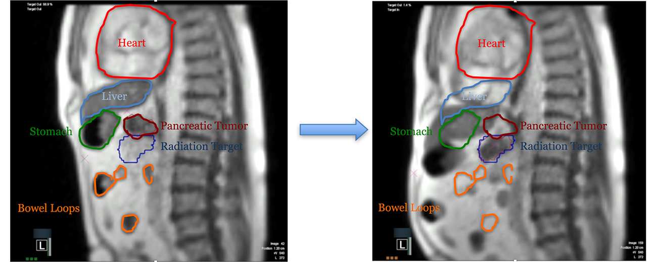 Pancreatic cancer shown here. The left image shows the patient’s anatomy during exhale, while the image on the right shows the anatomical change during a maximum inspiration breath hold (MIBH).