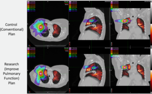 The image shows an example of patient-specific response-informed treatment planning.