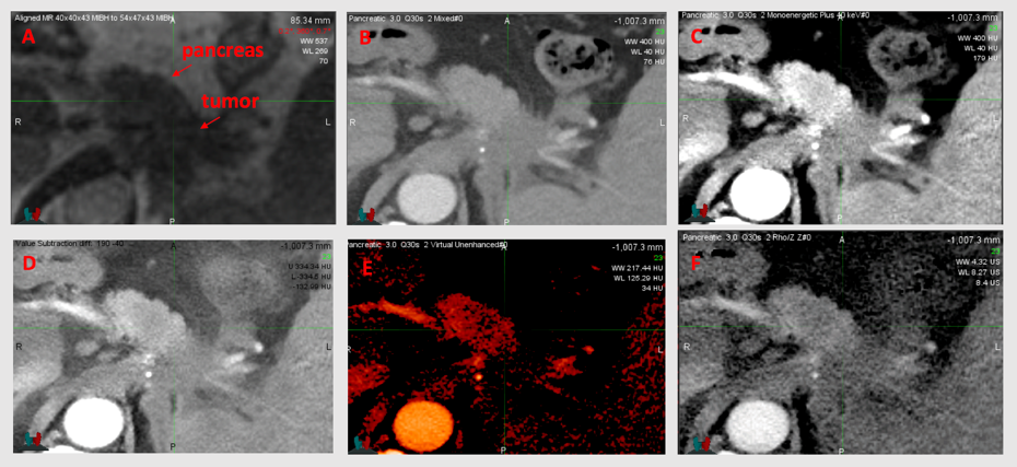 CT and dual-energy CT images of pancreatic tumor