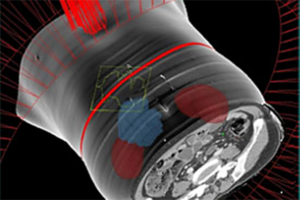 Pinnacle Smart Arc treatment planning system