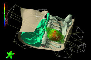 Varian_Eclipse software--lung cancer treatment planning