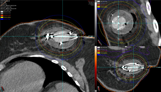 image of breast brachytherapy using a double-balloon applicator