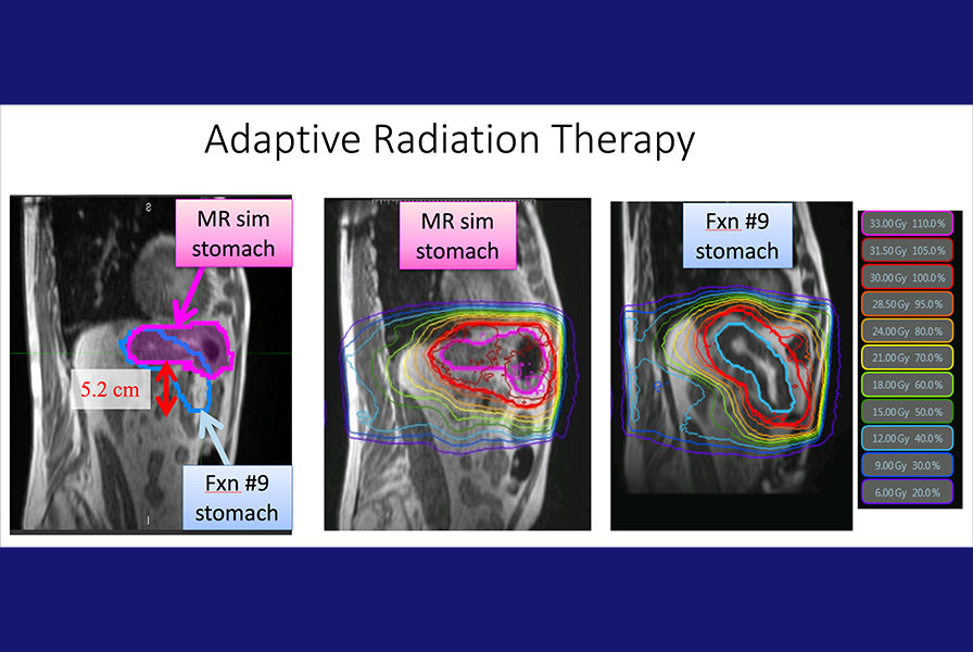 Adaptive Radiation Therapy