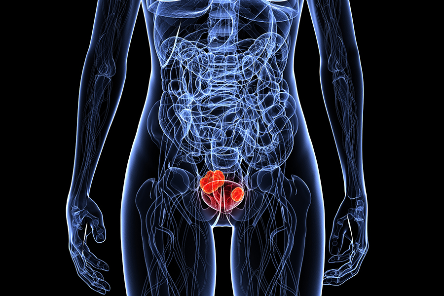 bladder cancer