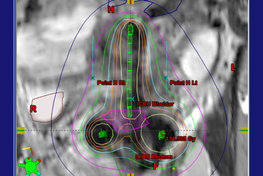 Brachytherapy