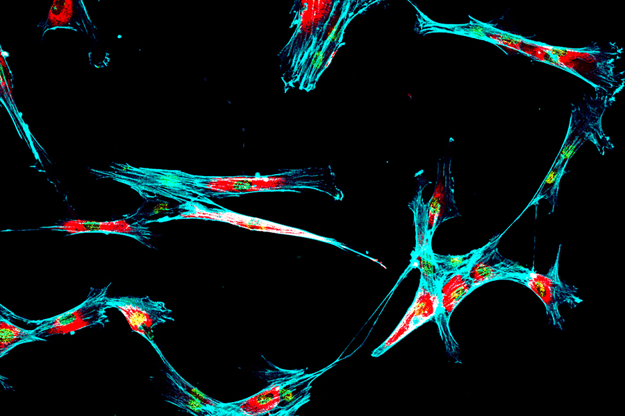 Immunofluorescence of multiple human tumor metastatic cells growing in tissue culture for research purposes