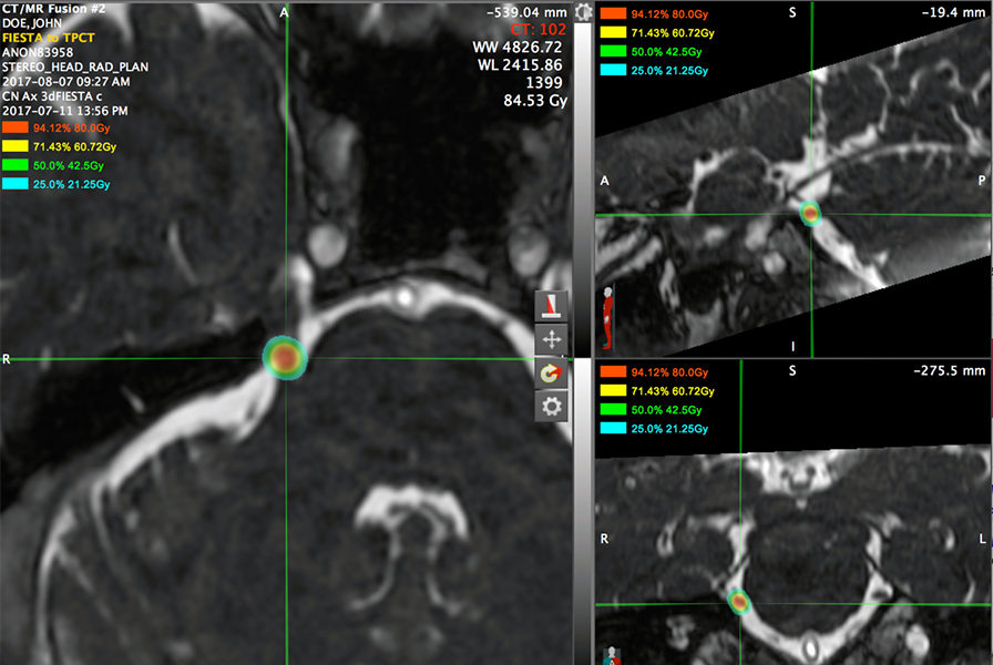 Radiosurgery