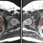 SpaceOAR separates prostate and rectum