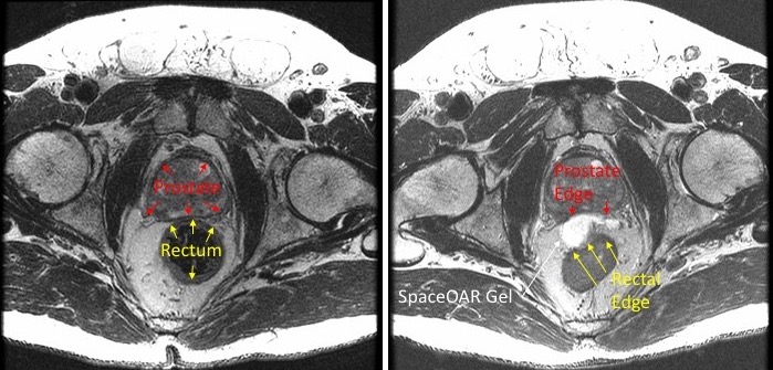 SpaceOAR separates prostate and rectum