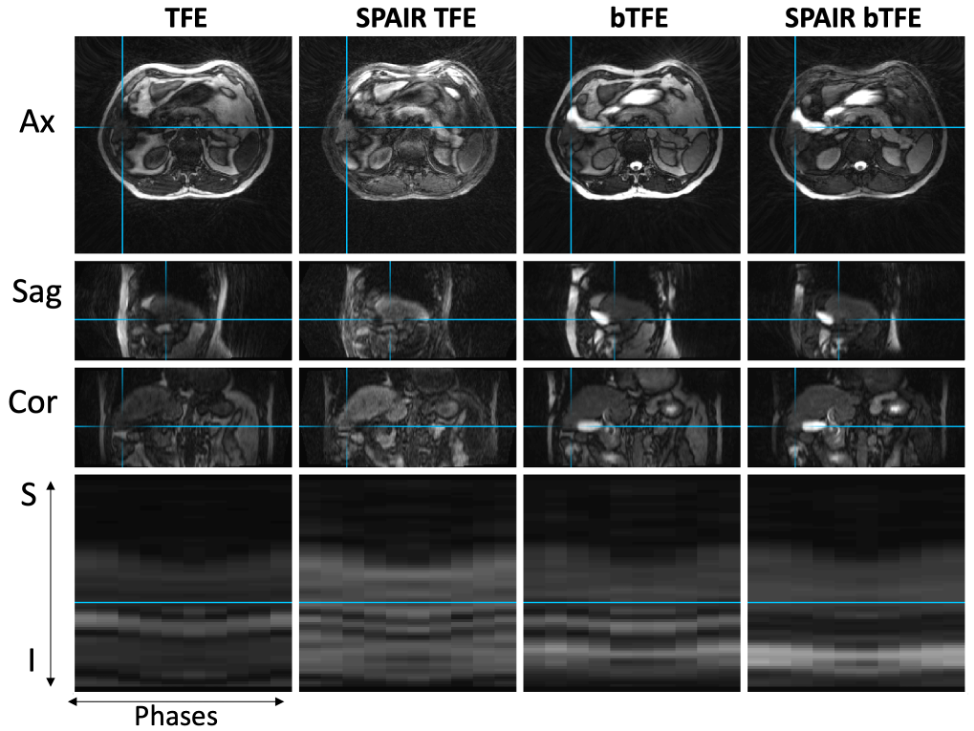 4D-MRI images