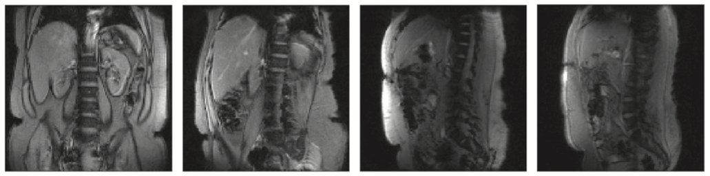 Four abdominal imaging slices at different orientations between Coronal and Sagittal