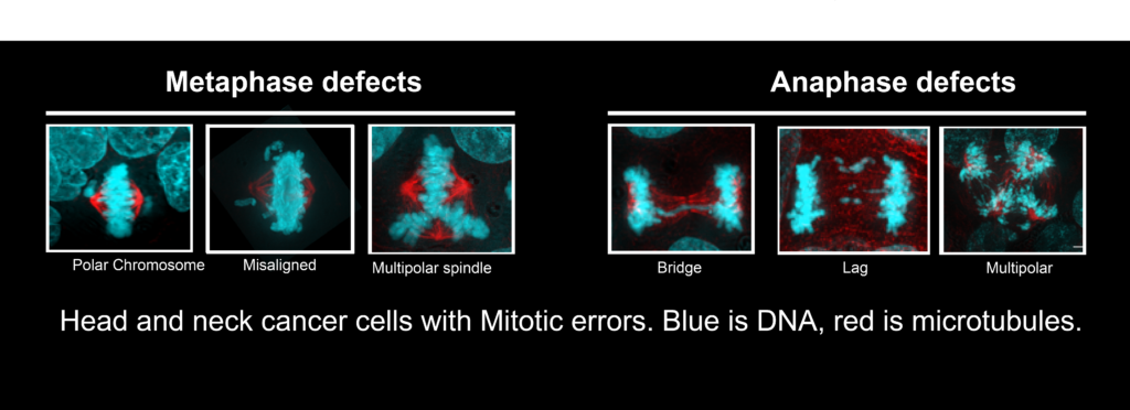 Micrographs of Head and neck cancer cells with mitotic errors.